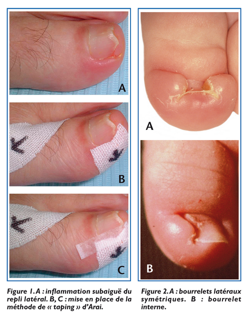 bourrelets latéraux congénitaux