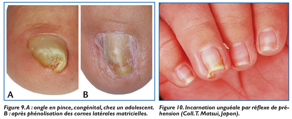 incarnation unguéale par réflexe de préhension